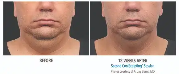 CoolSculpting result at Bella Medspa in Philadelphia, PA