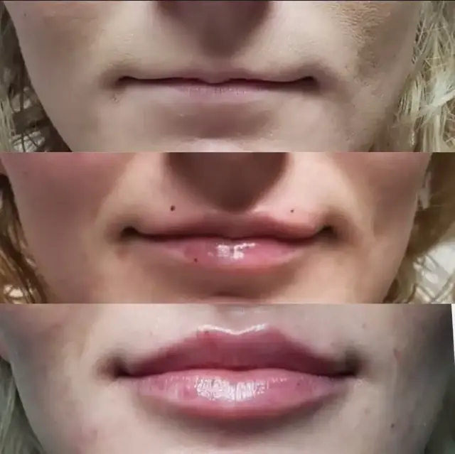 Lip Filler result at Bella Medspa in Philadelphia, PA