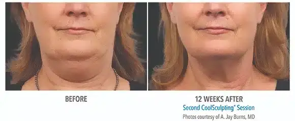 CoolSculpting result at Bella Medspa in Philadelphia, PA