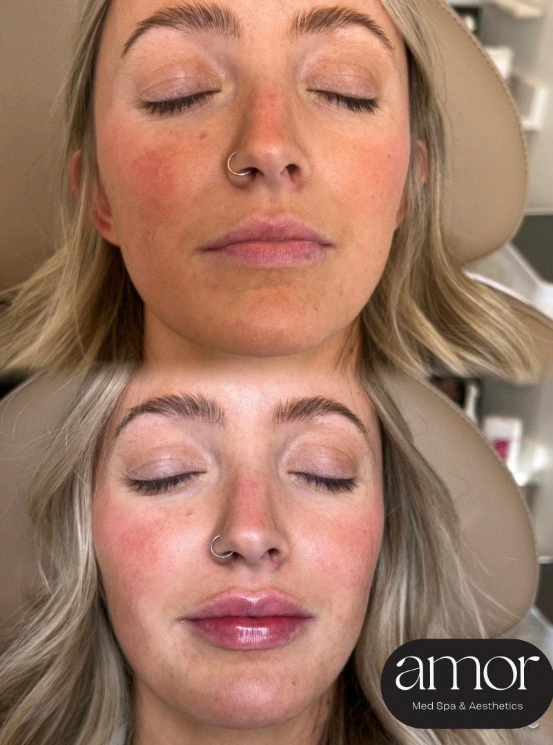 Amor Med Spa & Aesthetics lip filler result — St George, UT