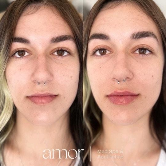 Lip Filler result at Amor Med Spa & Aesthetics in St George, UT
