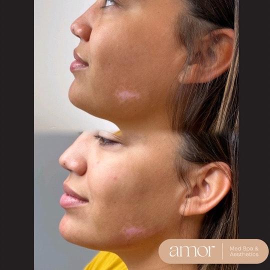 Jawline Filler result at Amor Med Spa & Aesthetics in St George, UT
