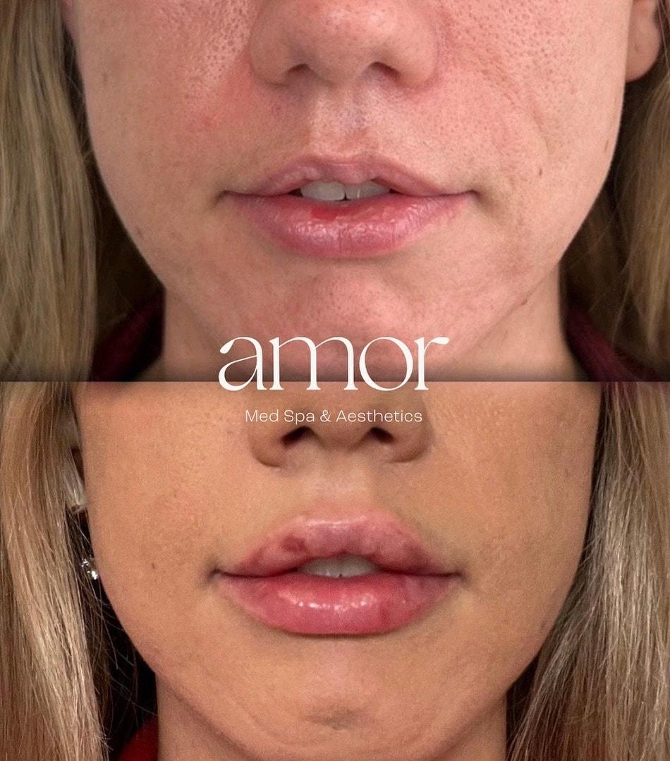 Amor Med Spa & Aesthetics lip filler result — St George, UT