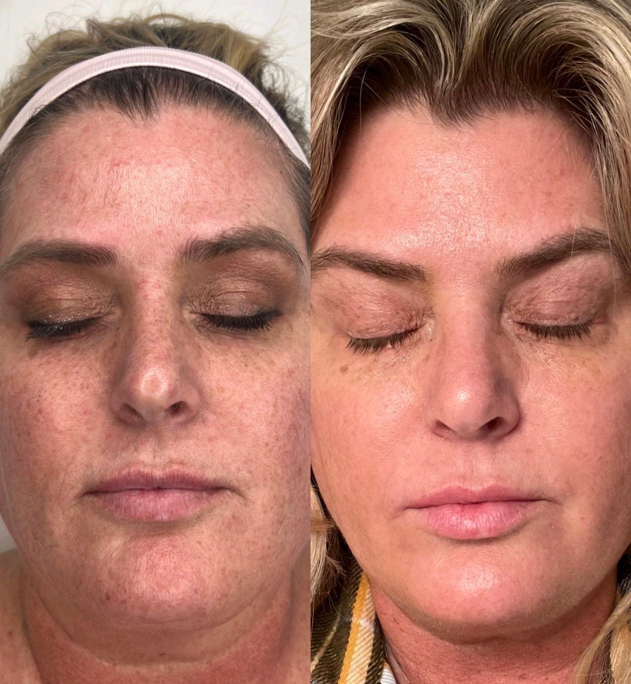 Amor Med Spa & Aesthetics photofacial result — St George, UT