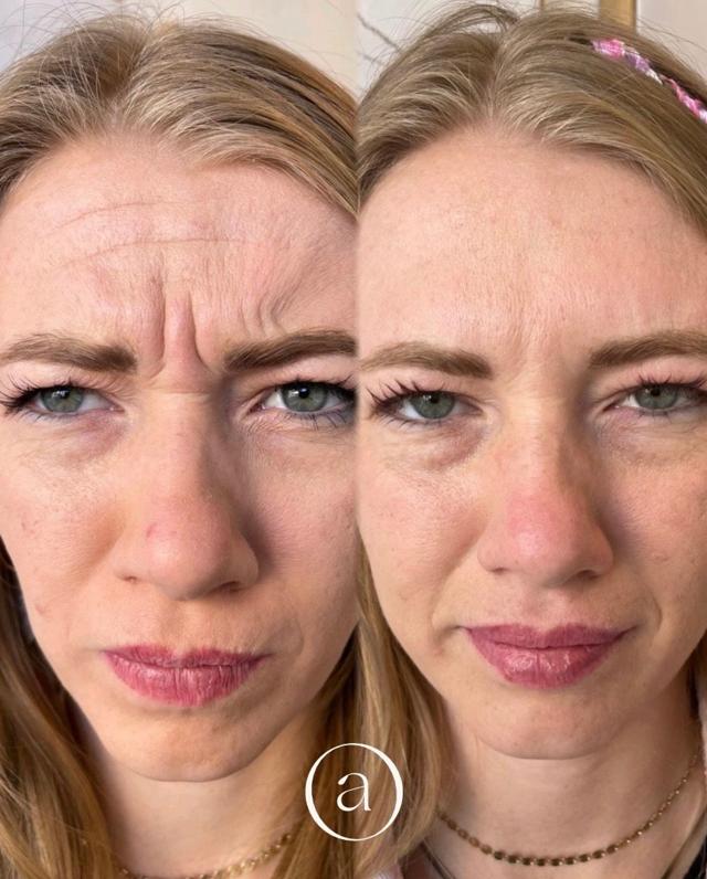 Botox result at Amor Med Spa & Aesthetics in St George, UT