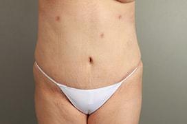 Tummy Tuck after at Utah Cosmetic Surgery in Murray, UT