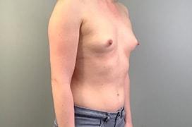 Fat Transfer Breast Augmentation before at Utah Cosmetic Surgery in Murray, UT