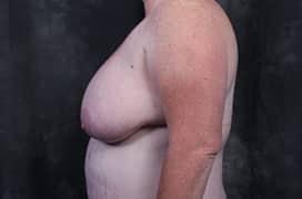 Breast Reduction before at Utah Cosmetic Surgery in Murray, UT