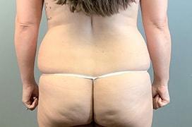 Liposuction before at Utah Cosmetic Surgery in Murray, UT