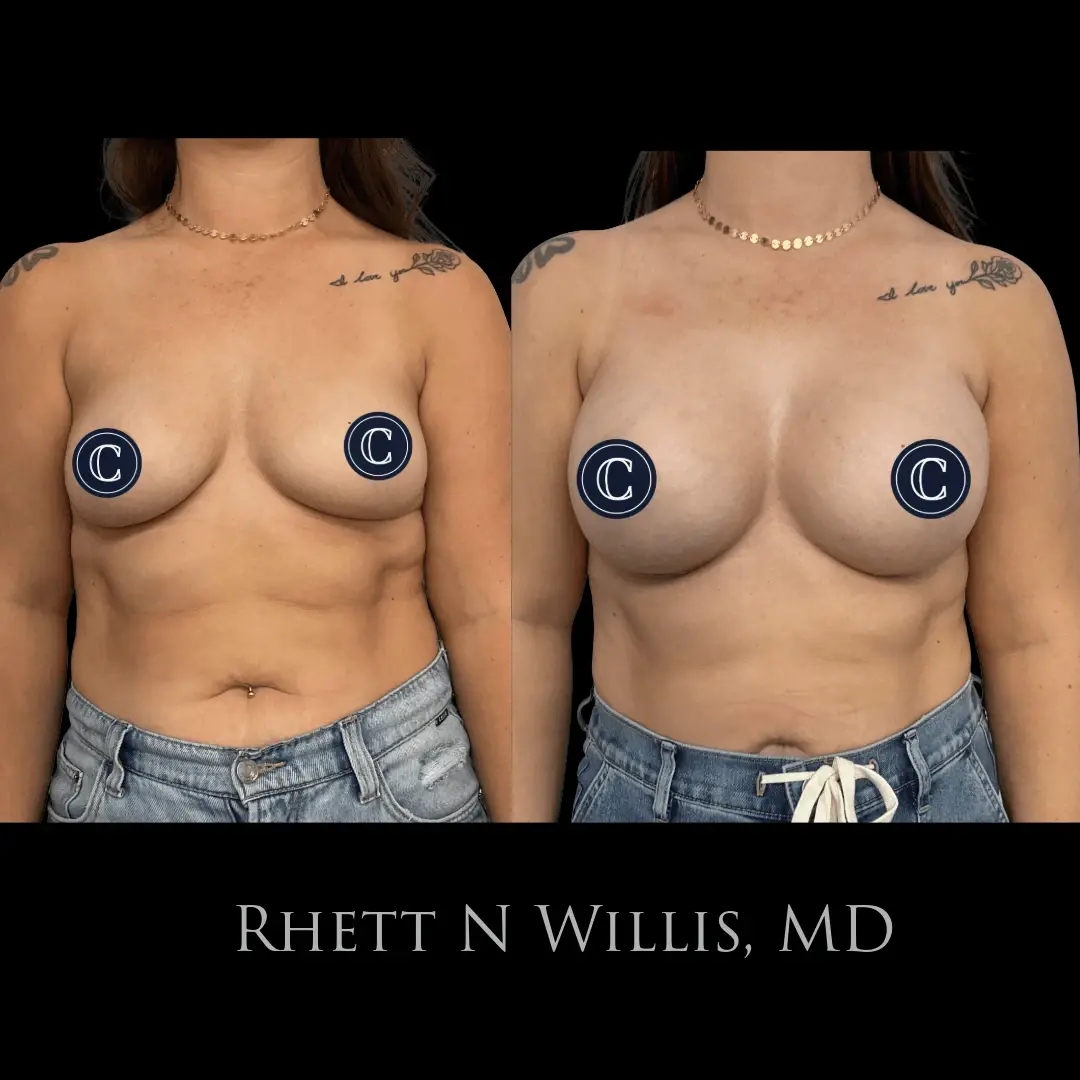 Utah Cosmetic Surgery breast augmentation result — Salt Lake City, UT