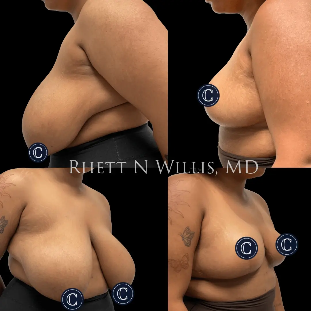 Utah Cosmetic Surgery breast reduction result — Salt Lake City, UT
