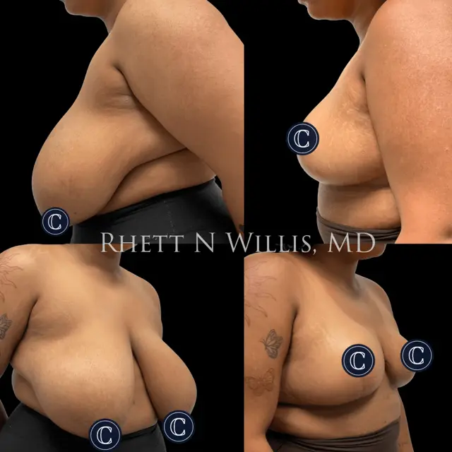 Breast Reduction result at Utah Cosmetic Surgery in Murray, UT