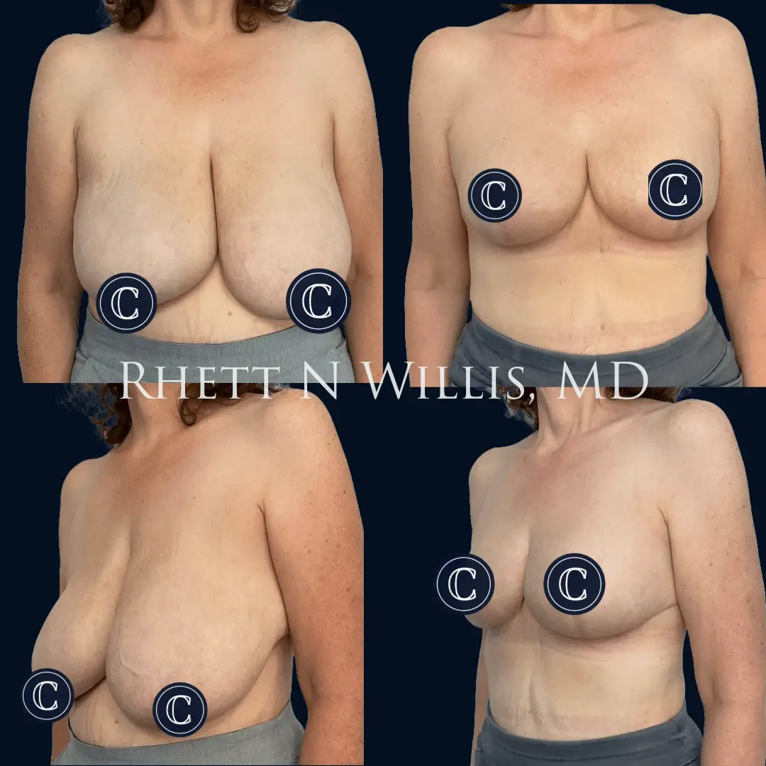 Utah Cosmetic Surgery breast reduction result — Salt Lake City, UT