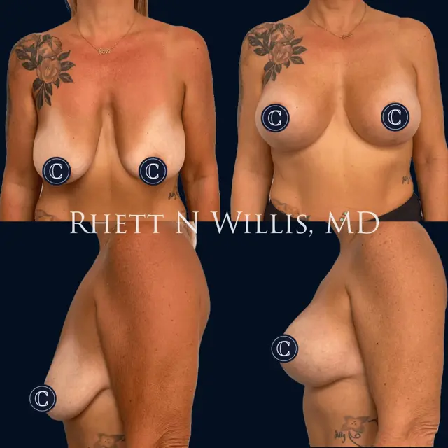 Breast Lift result at Utah Cosmetic Surgery in Murray, UT