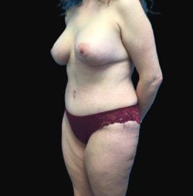 Mommy Makeover after at Utah Cosmetic Surgery in Murray, UT