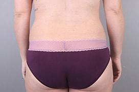Liposuction after at Utah Cosmetic Surgery in Murray, UT