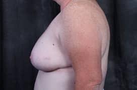 Breast Reduction after at Utah Cosmetic Surgery in Murray, UT