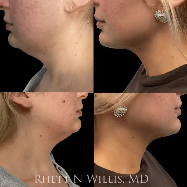 Neck Liposuction result at Utah Cosmetic Surgery in Salt Lake City, UT