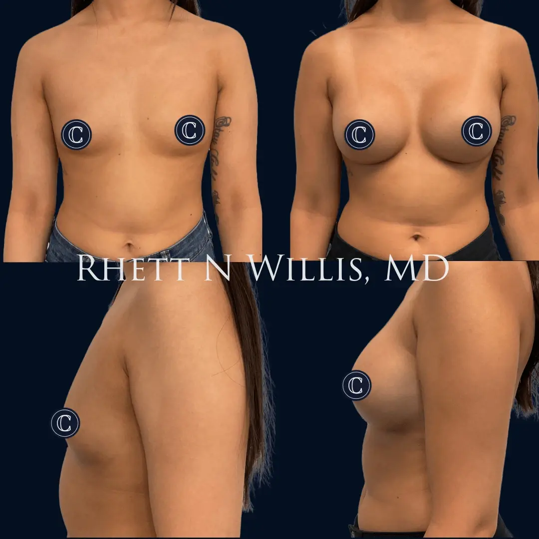 Utah Cosmetic Surgery breast augmentation result — Salt Lake City, UT