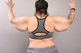 Arm Lift before at Utah Cosmetic Surgery in Murray, UT