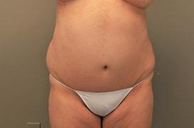 Tummy Tuck before at Utah Cosmetic Surgery in Murray, UT
