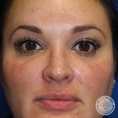 SKINHAUS Beauty blepharoplasty after — Nashville, TN