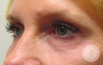 Blepharoplasty after at SKINHAUS Beauty in Nashville, TN