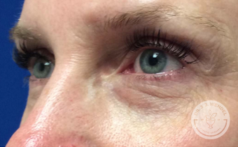 Blepharoplasty before at SKINHAUS Beauty in Nashville, TN