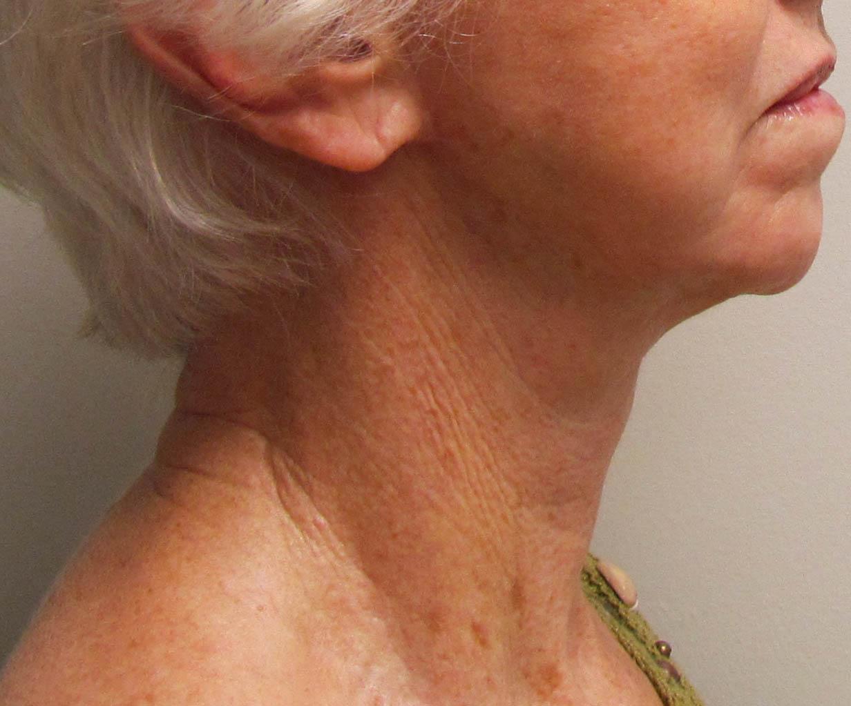 SKINHAUS Beauty neck lift after — Nashville, TN