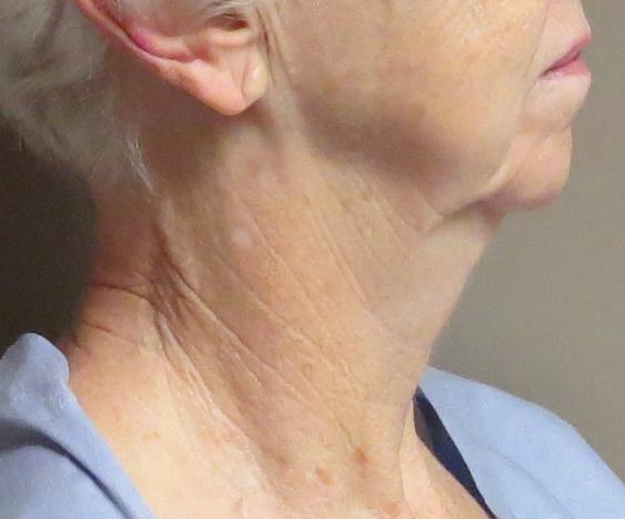Neck Lift before at SKINHAUS Beauty in Nashville, TN