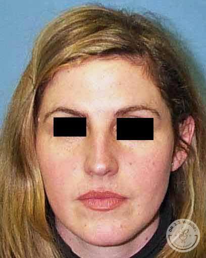 Rhinoplasty before at SKINHAUS Beauty in Nashville, TN