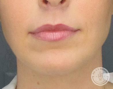 SKINHAUS Beauty chin implant after — Nashville, TN