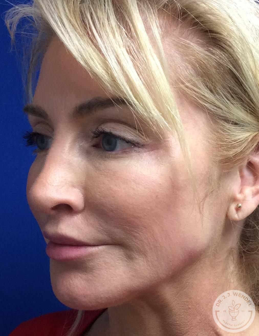 SKINHAUS Beauty rhinoplasty after — Nashville, TN