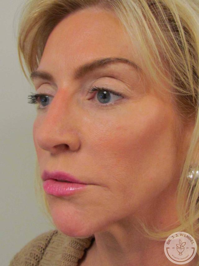 Rhinoplasty before at SKINHAUS Beauty in Nashville, TN