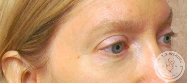 Blepharoplasty before at SKINHAUS Beauty in Nashville, TN