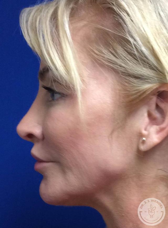 Rhinoplasty after at SKINHAUS Beauty in Nashville, TN