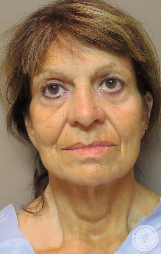 Deep Plane Facelift before at SKINHAUS Beauty in Nashville, TN