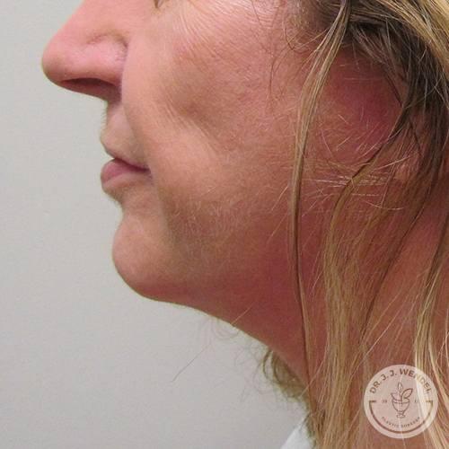 Chin Implant after at SKINHAUS Beauty in Nashville, TN
