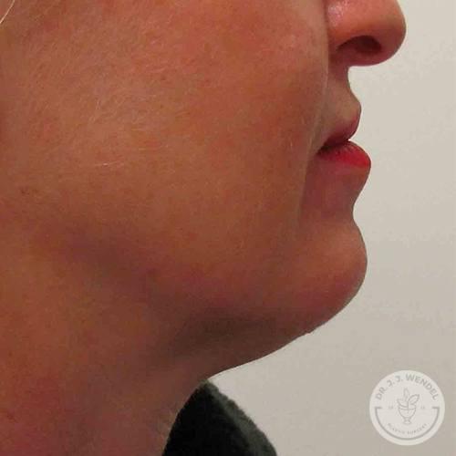 SKINHAUS Beauty chin implant after — Nashville, TN