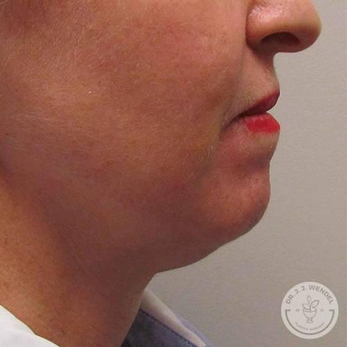 Chin Implant before at SKINHAUS Beauty in Nashville, TN