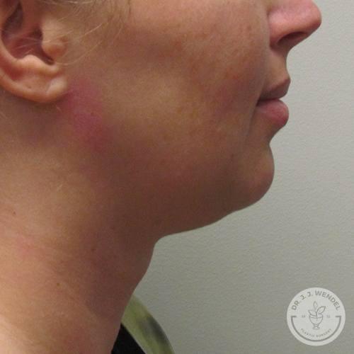 Chin Implant after at SKINHAUS Beauty in Nashville, TN