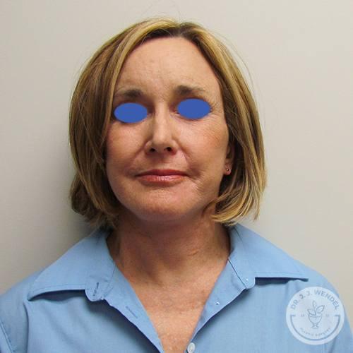 SKINHAUS Beauty facelift after — Nashville, TN