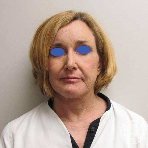 Deep Plane Facelift before at SKINHAUS Beauty in Nashville, TN