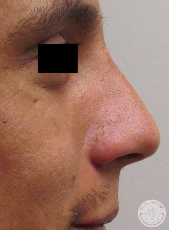 Rhinoplasty after at SKINHAUS Beauty in Nashville, TN