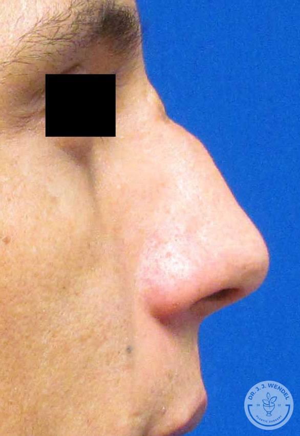 Rhinoplasty before at SKINHAUS Beauty in Nashville, TN