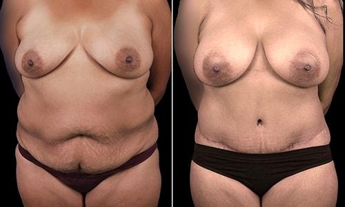 Mommy Makeover result at Joyce Aycock, MD in Denver, CO