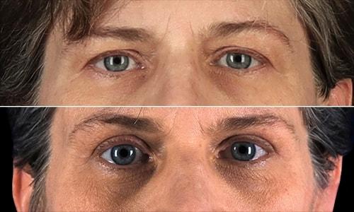 Joyce Aycock, MD eyelid lift result — Denver, CO