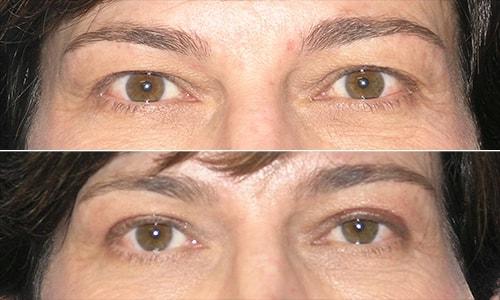 Joyce Aycock, MD eyelid lift result — Denver, CO