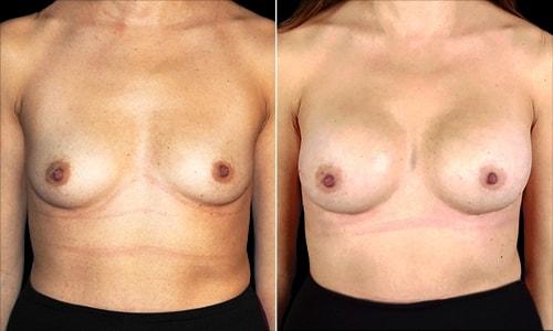 Joyce Aycock, MD breast augmentation result — Denver, CO