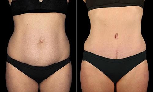 Tummy Tuck result at Joyce Aycock, MD in Denver, CO